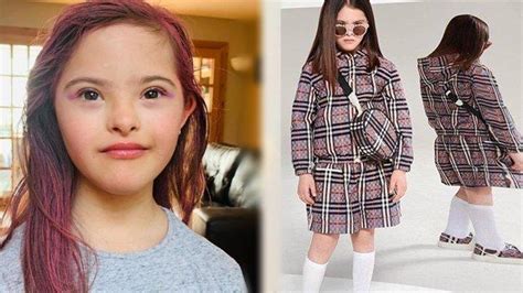 burberry down syndrome model|The nine.